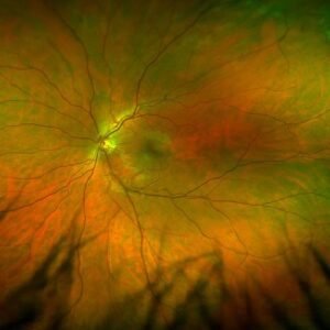 my retina